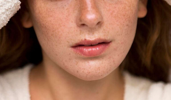 Косметолог поделилась правилами летнего ухода за кожей лица с родинками